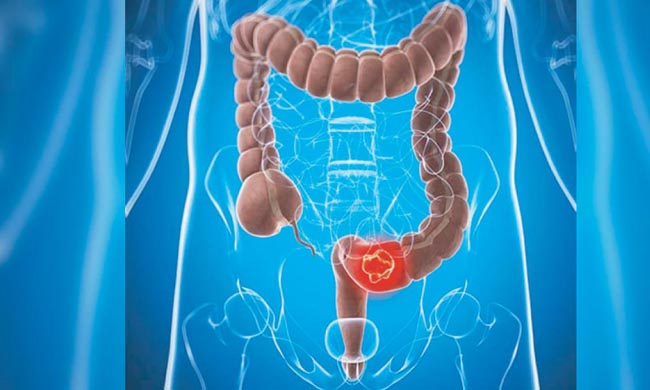 কোলন ক্যান্সার : কারণ, লক্ষণ ও পরীক্ষা
