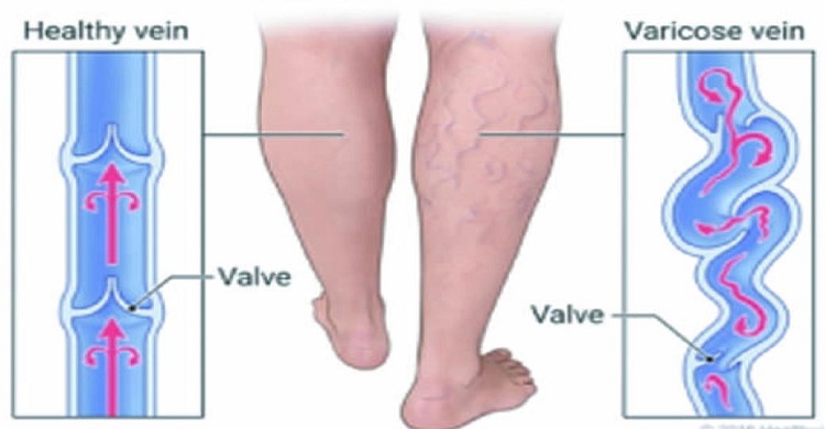 ভেরিকোজ ভেইনস: কারণ, লক্ষণ