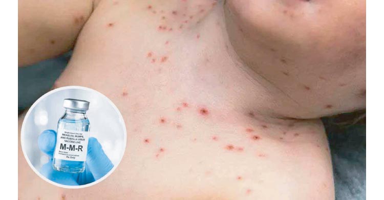 হঠাৎ কেন বাড়ছে হাম, প্রতিকারে কী করবেন