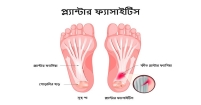 প্লান্টার ফাসাইটিস কী, কেন হয়