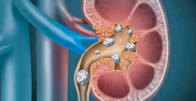 কিডনি পাথর প্রতিরোধের উপায়