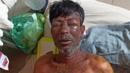 পরকীয়ার জেরে  ঘুমন্ত  স্বামীর ওপর স্ত্রীর এসিড নিক্ষেপ