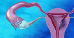 জরায়ু-মুখ ক্যান্সার : প্রতিরোধই উত্তম