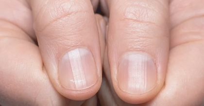 সবুজ নখ : বিলাস নয় ব্যাধি