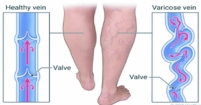 ভেরিকোজ ভেইনস: কারণ, লক্ষণ