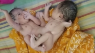 চাঁদপুরে দুই মাথা নিয়ে শিশুর জন্ম